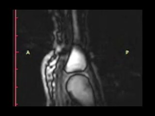 Real-time MRI of joint cracking