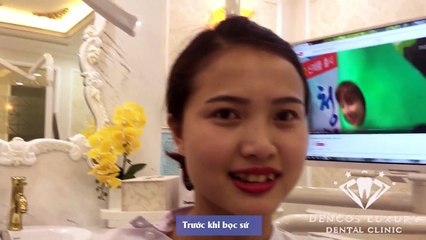 Hotgirl Lào Cai bọc sứ khắc phục răng khấp khểnh, xỉn màu - 0902685599