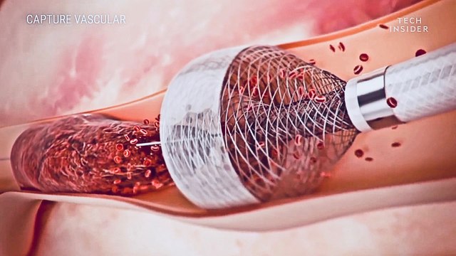 New Device Removes Blood Clots Much More Efficiently -MegaVac