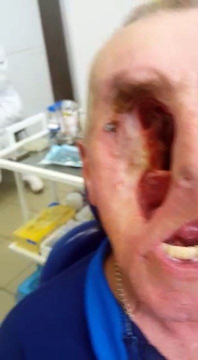 one eye man still alive without tension |amazing man