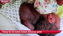 Hatay’da iki kafalı bebek dünyaya geldi