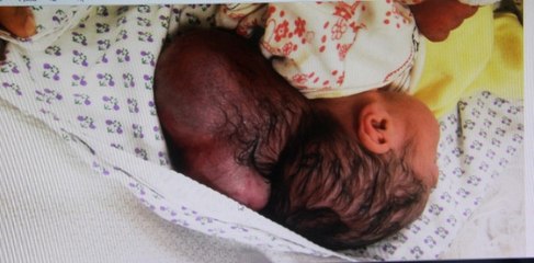 Hatay'da İki Kafalı Bebek Dünyaya Geldi