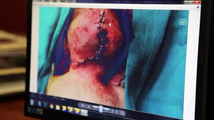 Kafasında kitleyle doğan bebek, sağlığına kavuştu - HATAY