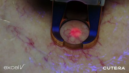 Now is the time to treat your veins for fab skin in the summer! See how it's done!