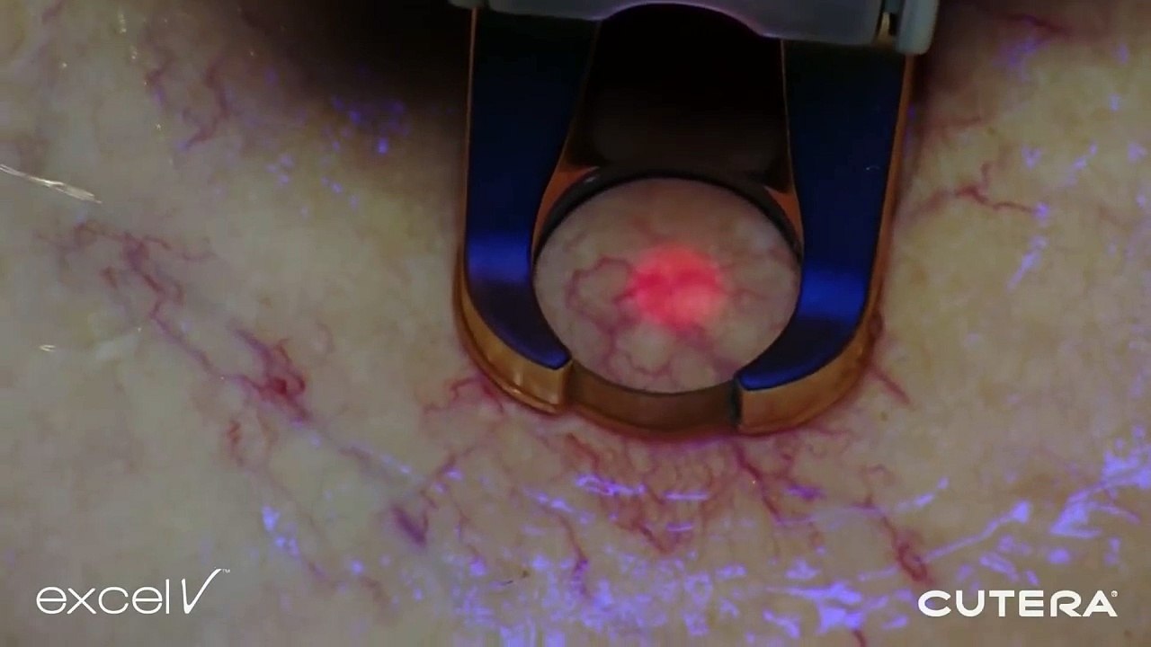 Now is the time to treat your veins for fab skin in the summer! See how it's done!