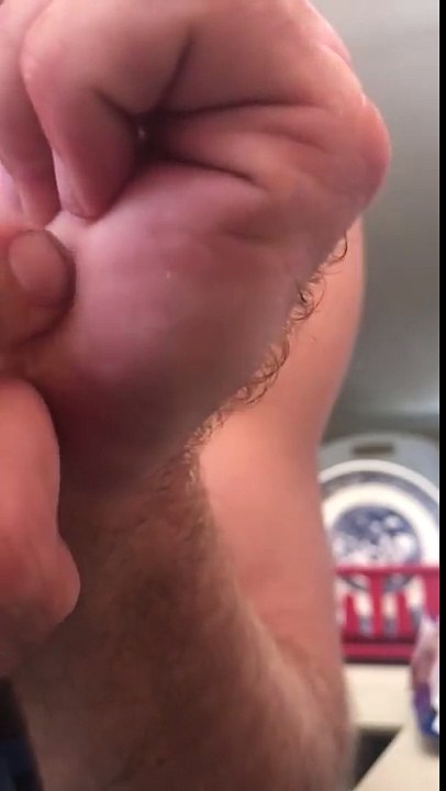 Il s'enlève une écharde géante de la main 10 jours après !