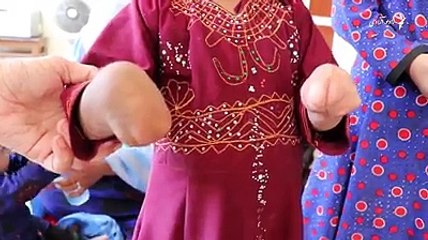 Tải video: حلیمه در انتظار دستان جدیداش ***********حلیمه سه و نیم ساله هر دو دست‌اش را به دلیل سوختگی شدید از دست داده است.حالا دهکده آلمان امید داشتن دستان او را به وا