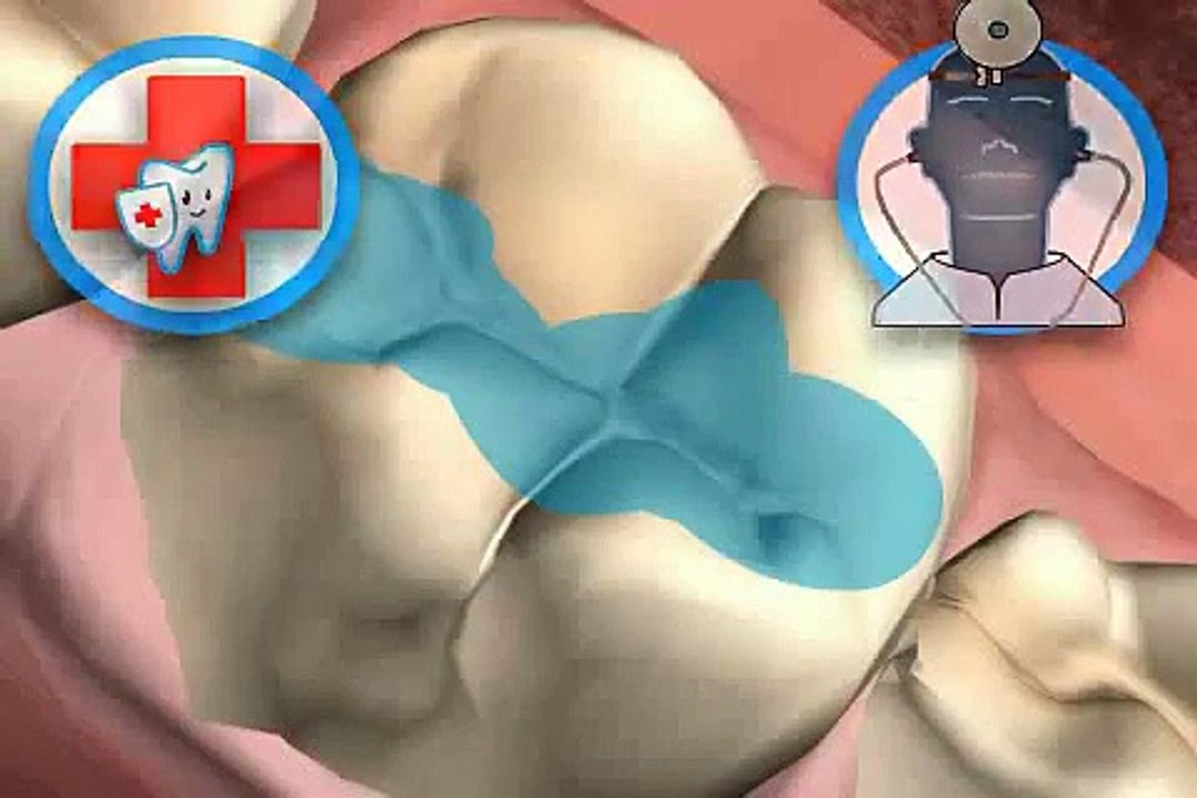 Wie vermeindet man Fissurenkaries?