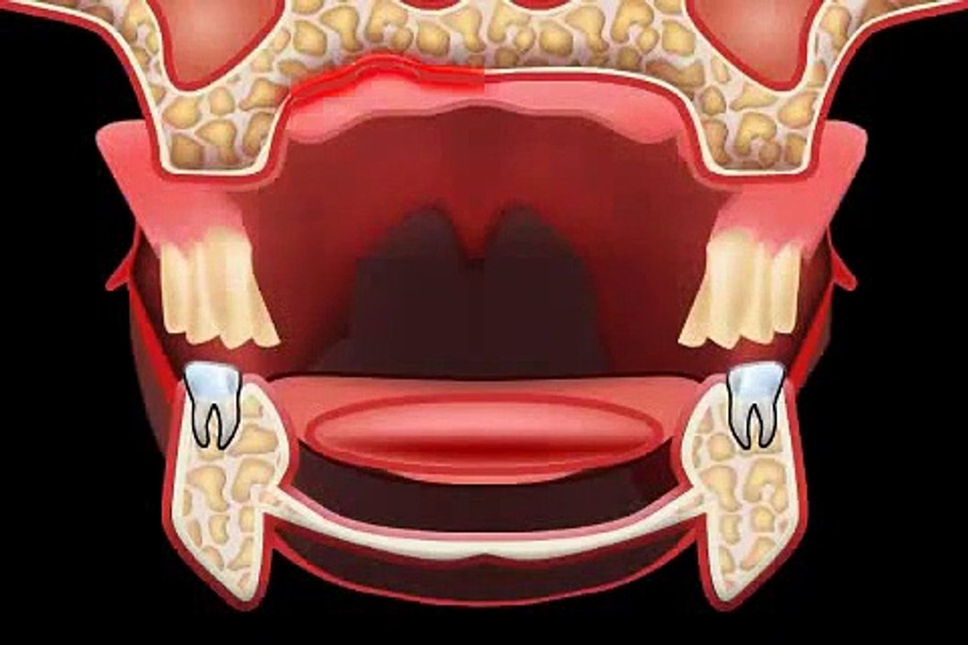 Was tun bei Zahnprothesen Druckstellen
