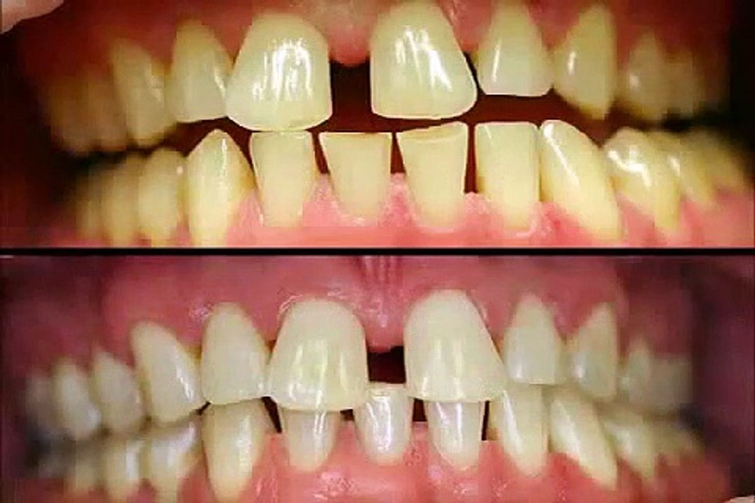 Unterschiede beim Zahn Bleaching - Zahnaufhellung