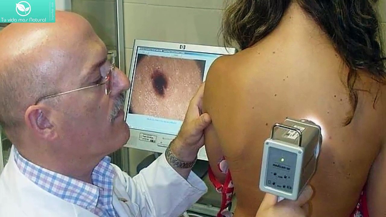 Aumenta cáncer de piel en población más joven