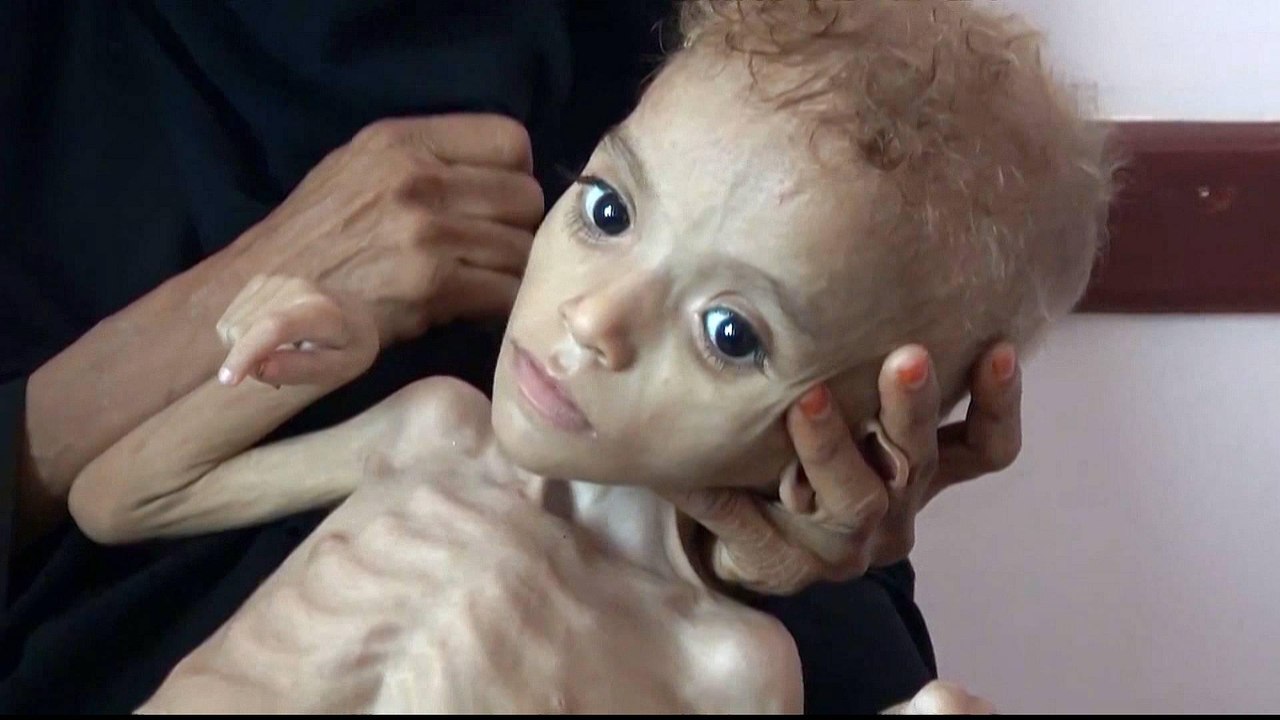 Yemen: 85,000 children may have died from starvation