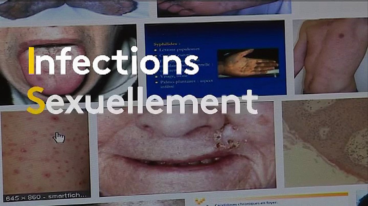 Virus du Sida : la PrEP, protection contre le Sida, pas contre les IST