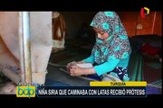 Turquía: niña con desorden congénito que caminaba con latas, recibió prótesis