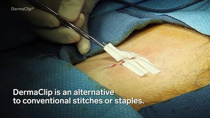 Needle-Less Alternative To Stitches