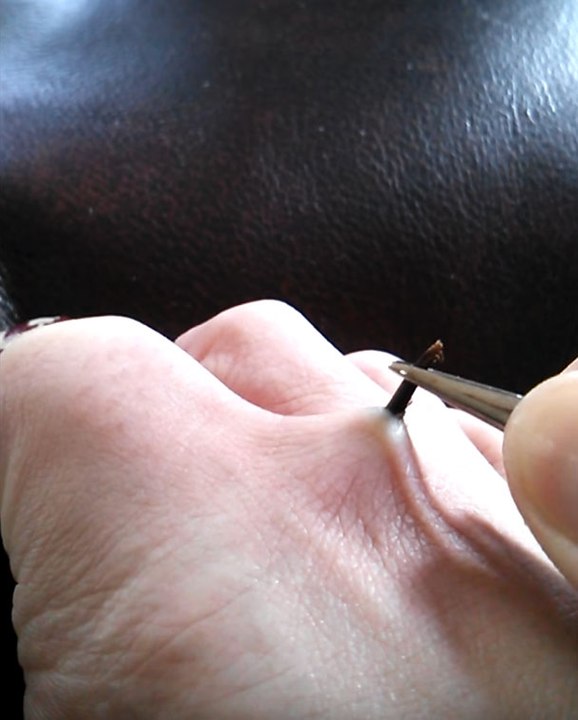 Une épine retirée d’un pied avec une pince à épiler