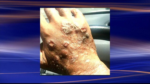 US: Monsanto on trial over Roundup poisoning case