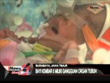 Bayi Kembar Lima Mengalami Beberapa Gangguan Fungsi Organ Tubuh - iNews Siang 25/06
