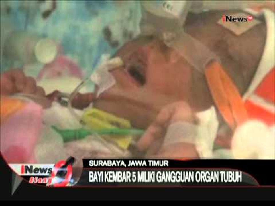 Bayi Kembar Lima Mengalami Beberapa Gangguan Fungsi Organ Tubuh - iNews Siang 25/06