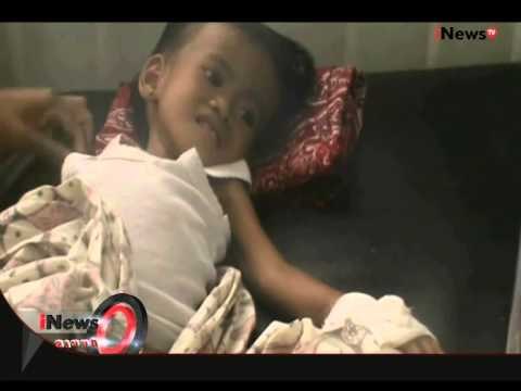 Bocah Usia 2 Tahun Divonis Gizi Buruk Di Padang Lawas, Sumut - iNews Siang 24/08