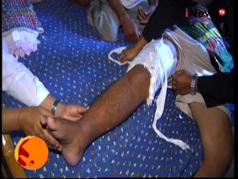 Patah Tulang Cimande - iNewspedia