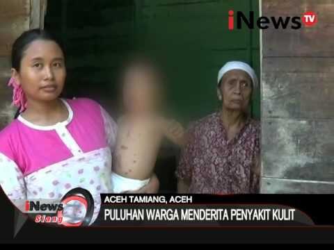 Kemarau panjang di Aceh Tamiang membuat warga menderita penyakit kulit - iNews Siang 31/03