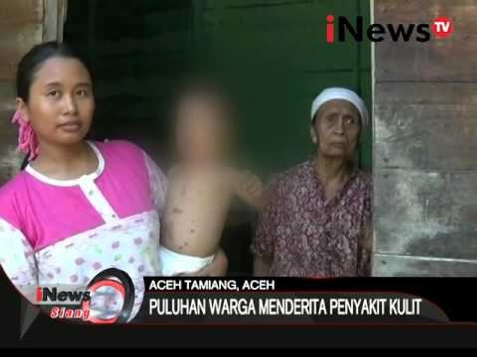 Kemarau panjang di Aceh Tamiang membuat warga menderita penyakit kulit - iNews Siang 31/03