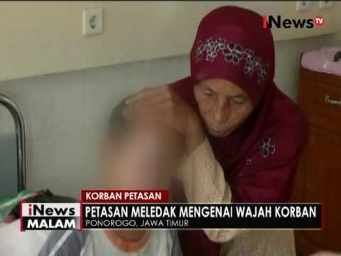 Muka kena petasan, seorang bocah di Ponorogo jalani perawatan intensif - iNews Malam 13/06