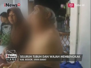 Oknum Korupsi Bahagia, Warga Miskin Penderita Tumor Puluhan Tahun Hanya Pasrah - iNews Siang 11/05