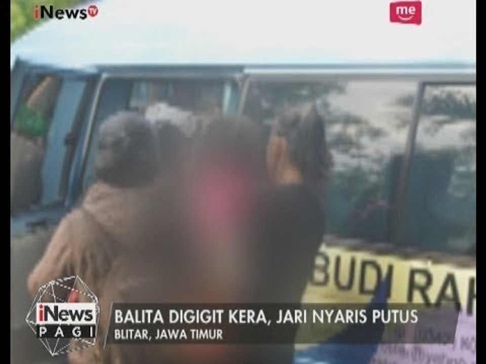 Seorang Balita di Blitar DiRawat di RS Usai Jarinya Nyaris Putus Digigit Kera - iNews Pagi 02/07