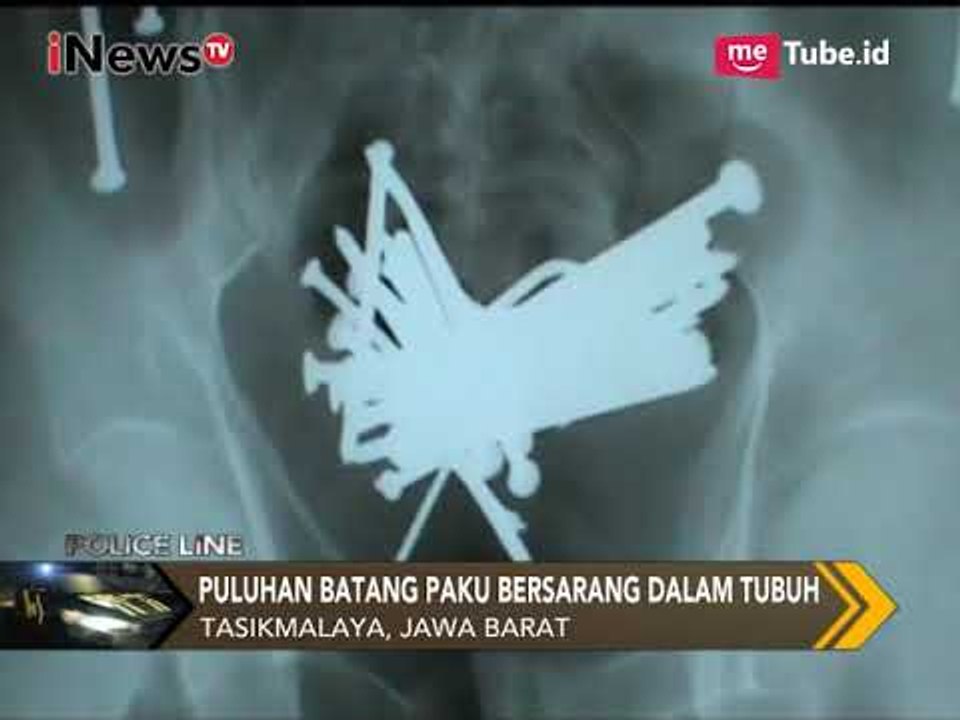 Heboh!! Di Dalam Perut Seorang Pria Terdapat Puluhan Paku yang Bersarang - Police Line 01/11
