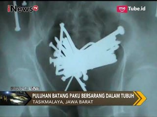 Heboh!! Di Dalam Perut Seorang Pria Terdapat Puluhan Paku yang Bersarang - Police Line 01/11