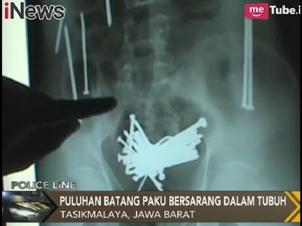 Miris!! Sakit Perut Selama 3 Hari, Ternyata Perut Pria Ini Berisi Paku - Police Line 04/11