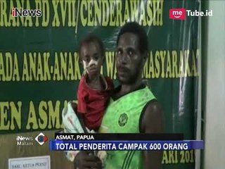 Dalam 4 Bulan, 67 Anak Asmat Meninggal akibat Campak dan Gizi Buruk - iNews Malam 18/01