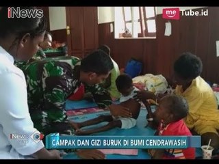 Puluhan Anak Terindikasi Campak dan Gizi Buruk Akhirnya Dapatkan Pengobatan Rutin - iNews Pagi 28/01