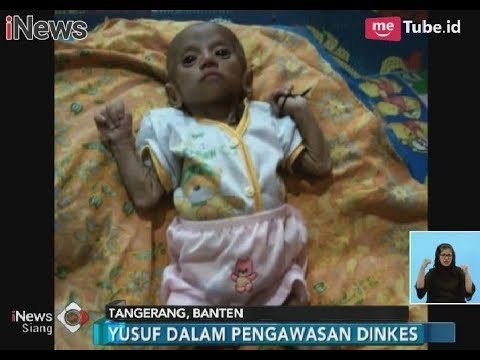25 Anak di Tangerang Derita Kurang Gizi, Bukan Gizi Buruk - iNews Siang 30/01