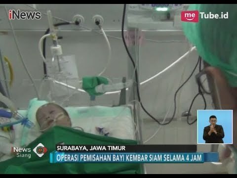 Usai Dioperasi, Bayi Kembar Siam di Surabaya Akhirnya Berhasil Dipisahkan - iNews Siang 01/02