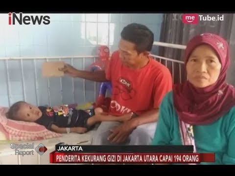 Ironis! Anggaran Belanja Melimpah, Anak Ibu Kota Masih Banyak Terserang Gizi Buruk - Special Report