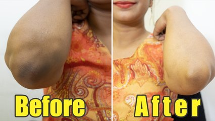 Effective Home Remedy To Lighten Dark Elbows | Boldsky
