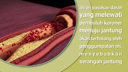 SERANGAN JANTUNG - Penyebab dan Tanda Penyakit Jantung