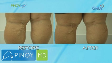 Pinoy MD: Solusyon sa varicose veins, alamin