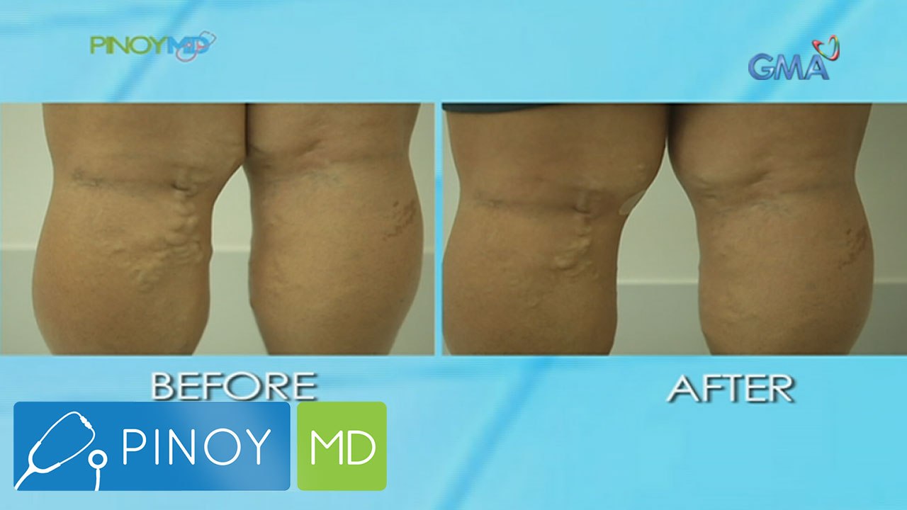 Pinoy MD: Solusyon sa varicose veins, alamin