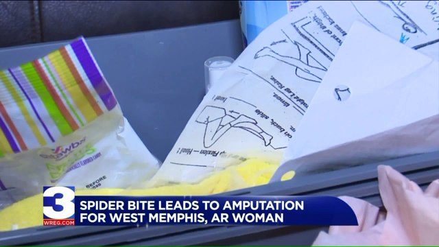 Woman`s Leg Amputated After She Was Bitten by Brown Recluse Spider