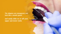 Invisalign® Orthodontics - North York - Quad Dental Clinic