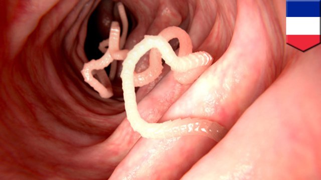 Tingling sensation in woman's feet turns out to be parasite in spine