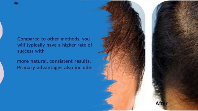Advantages of PRP for Hair Growth - Canada MedLaser Clinics