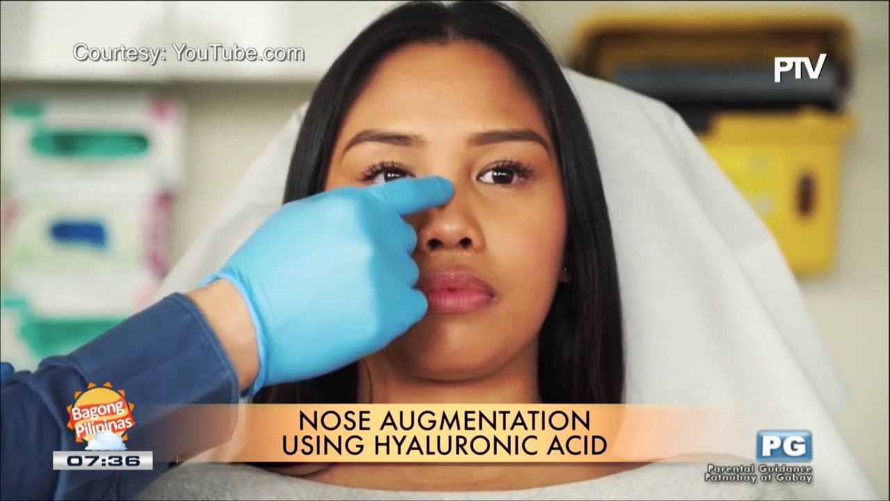 DERMAESTHETIQUE Nose job using hyaluronic acid video Dailymotion