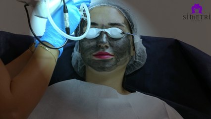 Karbon Peeling uygulaması