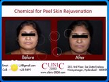 Chemical for Peel Skin Rejuvenation - Laser Skin Resurfacing [360p]
