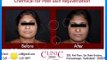 Chemical for Peel Skin Rejuvenation - Laser Skin Resurfacing [360p]